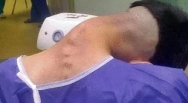 أطباء يوثقون حالة نادرة لمريض أصيب بـ"متلازمة الرأس المتدلي" بسبب تعاطي المخدرات!