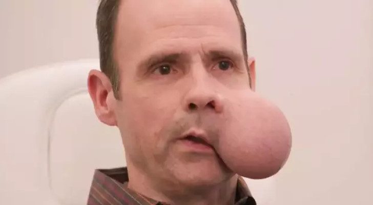 "يخيف الأطباء": شاب يعاني من ورم في وجهه يزن 4.5 كجم!