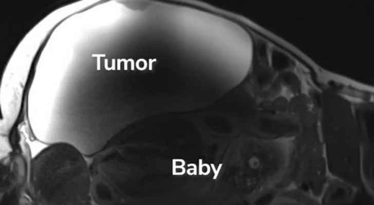دخلت المستشفى لاستئصال ورم… فخرجت تحمل طفلا لم تكن تعلم بوجوده!