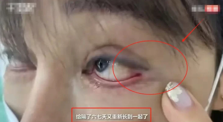 خطأ تجميلي صادم في الصين.. خياطة مقلة عين سيدة بجفنها تتركها بعاهة مستمرة!