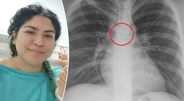 شابة تكتشف أن سعالها المزمن سببه قرط أنف استقر داخل رئتها!