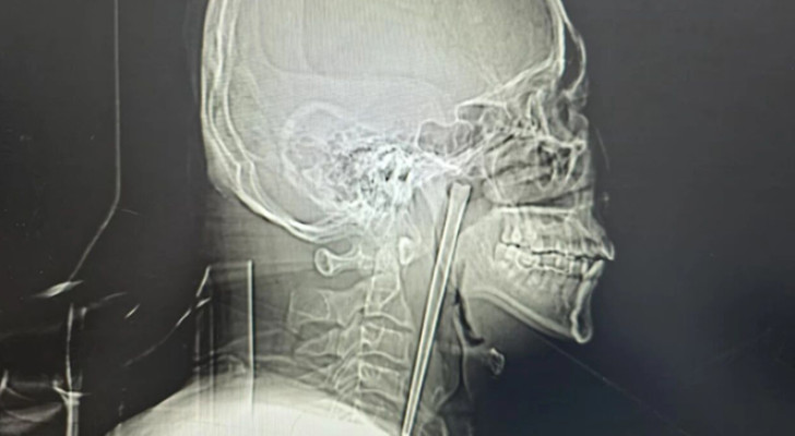 8 سنوات بعصا معدنية في حلقه! قصة صادمة لرجل تجاهل الألم حتى وصل إلى حافة الخطر